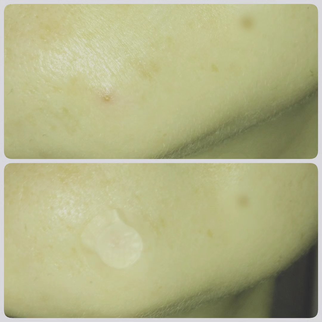 大熊製薬 トラブルケアパッチのクチコミ「＼マイクロニードルの付いたニキビパッチ／
★ニキビパッチトゥルーダイブ★

トゥル一ダイブは肌.....」（3枚目）