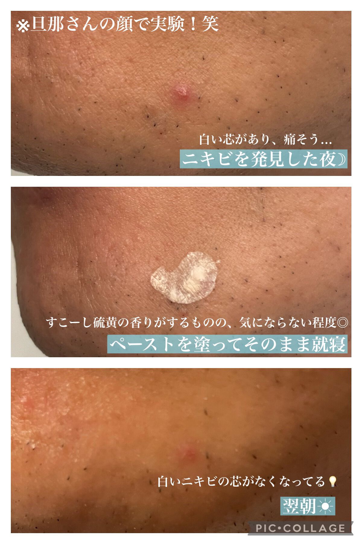 ニキトル薬用アクネスポッツペースト/タイムレスキュー/美容液を使ったクチコミ（2枚目）