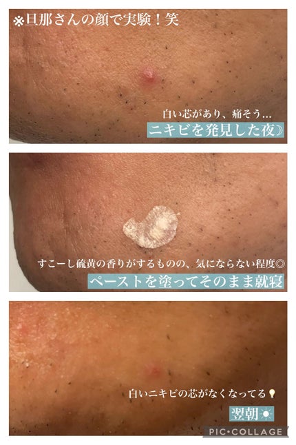 ニキトル薬用アクネスポッツペースト/タイムレスキュー/美容液を使ったクチコミ(2枚目)