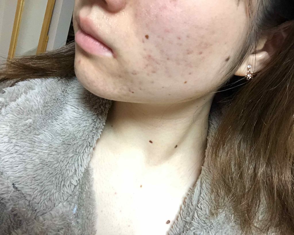 マンスリースキンケアプログラム(旧)/APEX/スキンケアキットを使ったクチコミ(4枚目)