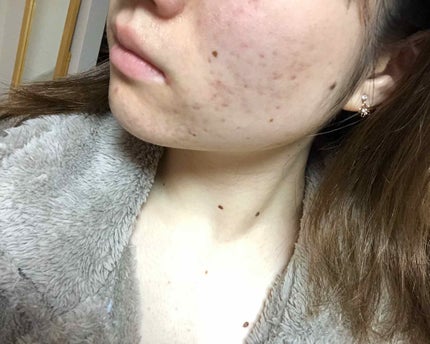 マンスリースキンケアプログラム(旧)/APEX/スキンケアキットを使ったクチコミ(4枚目)