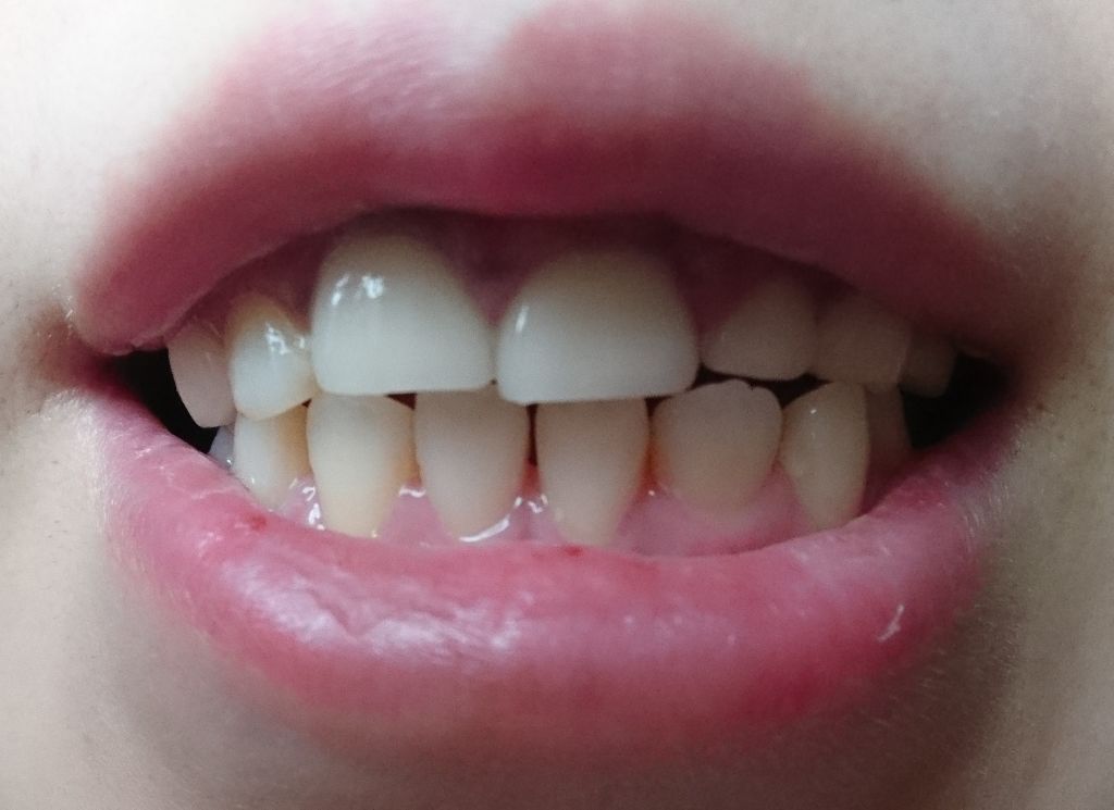 ホワイトニングペースト/Smile Cosmetique/歯磨き粉を使ったクチコミ（3枚目）