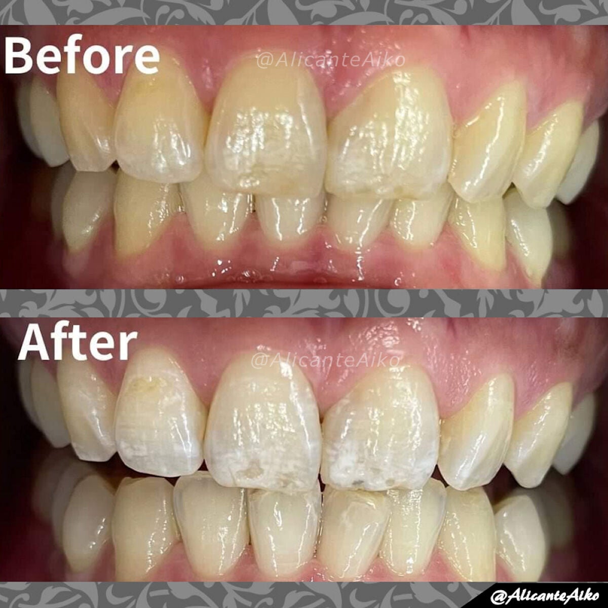 ありあいちゃん@いいね返し100 on LIPS 「📌ビフォアフ有り!痛くない歯のホワイトニング!!3回行ってきま..」(4枚目)