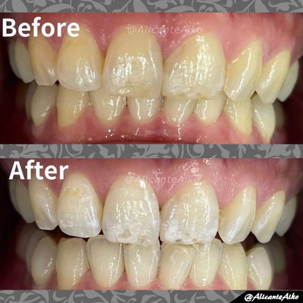 ありあいちゃん@いいね返し100 on LIPS 「📌ビフォアフ有り!痛くない歯のホワイトニング!!3回行ってきま..」(4枚目)