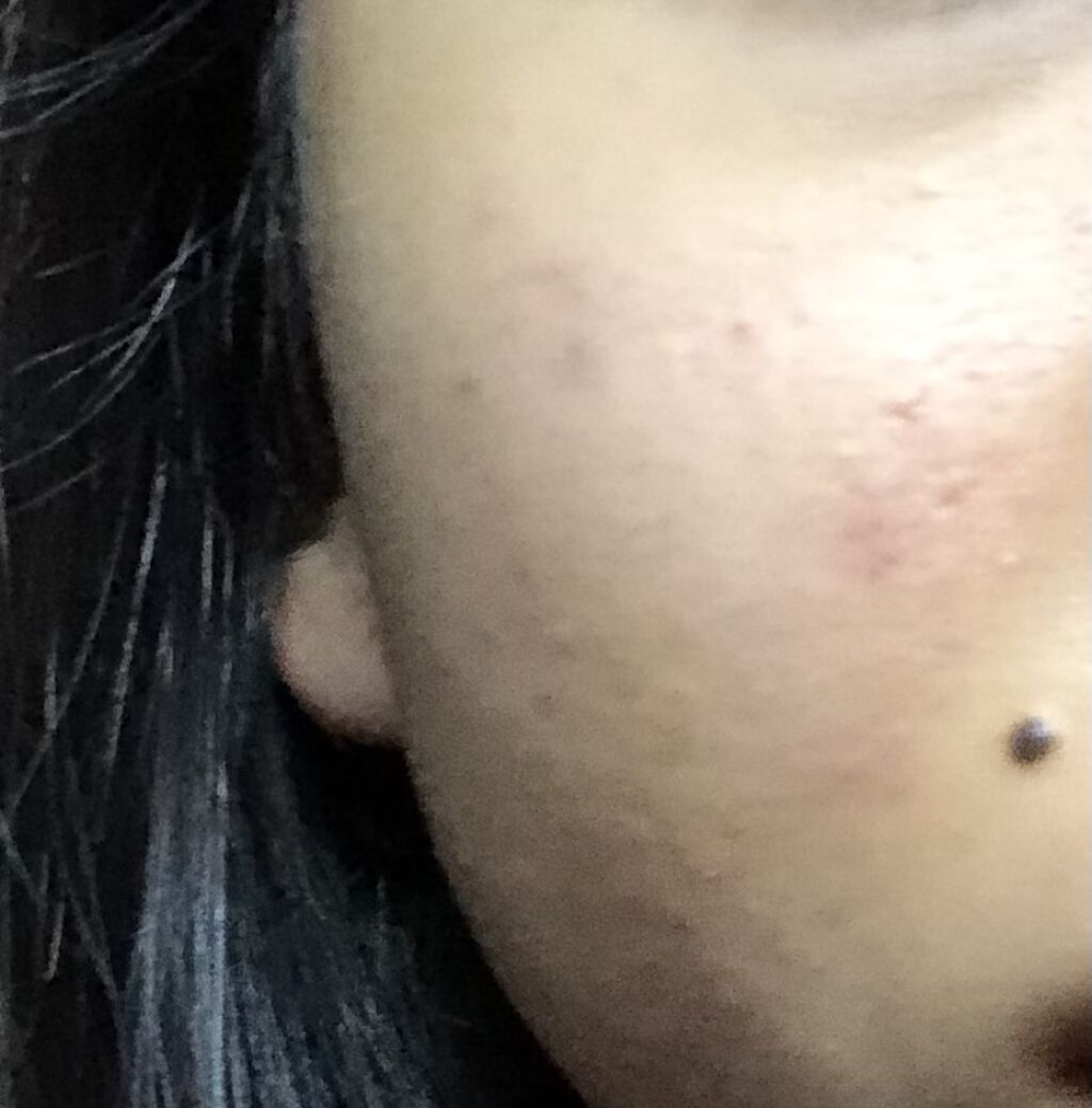 ロゼット洗顔パスタ アクネクリア/ロゼット/洗顔フォームを使ったクチコミ（1枚目）