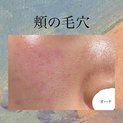 ペち on LIPS 「毛穴コンプレックス、お助け下さい!はじめまして!長年悩んでいる..」(5枚目)