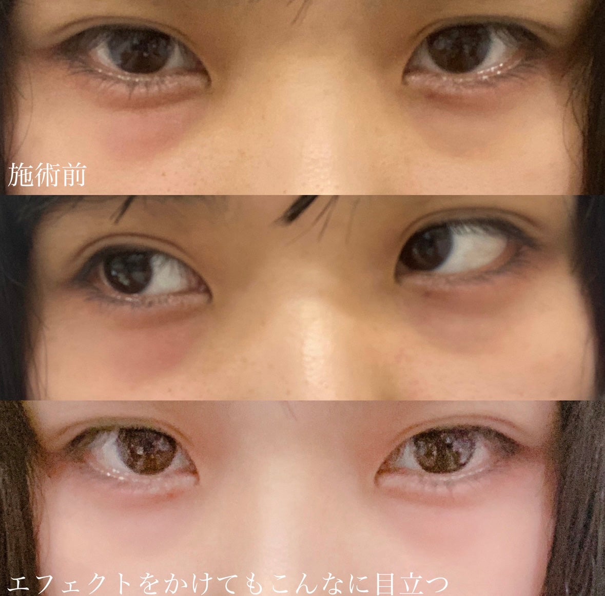 ERIKA on LIPS 「目の下のふくらみ取りをしました!目の下のふくらみとは、クマ治療..」(2枚目)