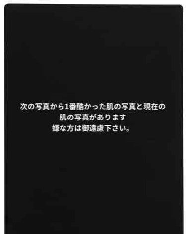 初投稿です<(＿ ＿)>
長いですがぜひ、お願い致します。

最後にも書いてありますが最初に言うと
2枚目から3枚目までは約3ヶ月間の肌の進歩です。自分がいつまでに綺麗になりたいのと、目指したい肌目標を