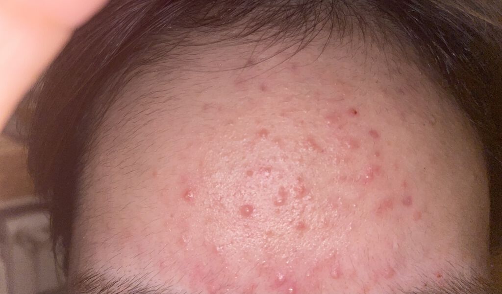 モイストバランス  ローション/ACSEINE/化粧水を使ったクチコミ（1枚目）