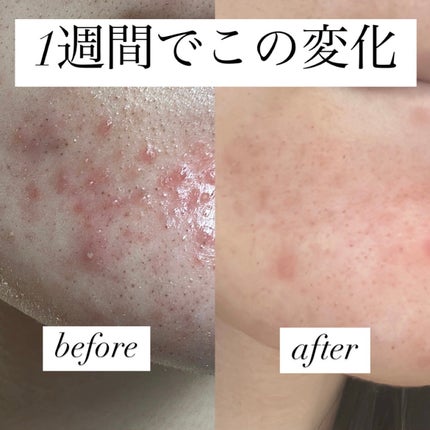 ドクダミ80%スージングアンプル/Anua/美容液を使ったクチコミ(1枚目)