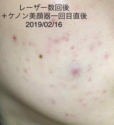 家庭用脱毛器 ケノン Ke Non エムテックを使った口コミ 目指せニキビ跡撲滅 たゃの美顔器レポvo By たゃ クリア冬ブライト夏ソフエレウェーブ 混合肌 代前半 Lips