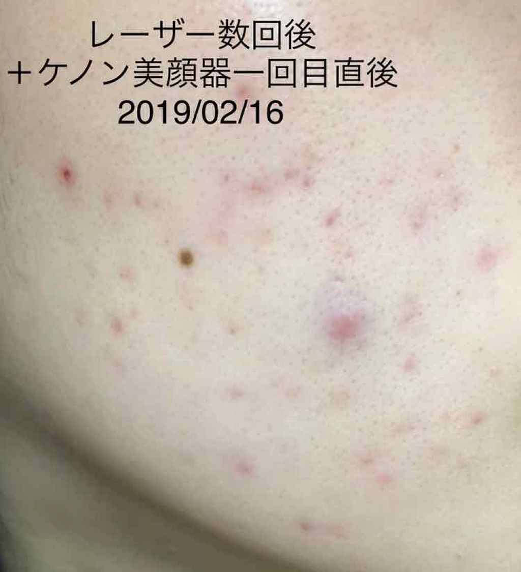 家庭用脱毛器 ケノン(ke-non)|エムテックを使った口コミ - 《目指せ