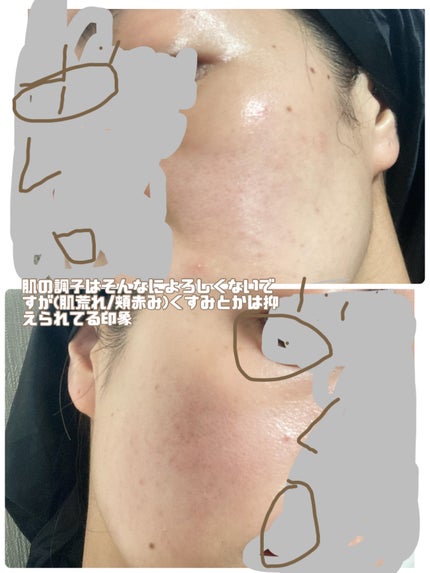 ナイアシンアミドブレミッシュケアセラム/ONE THING/美容液を使ったクチコミ(4枚目)