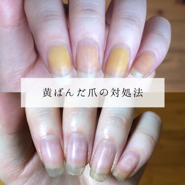 6ステップネイルケア Daisoの口コミ 超優秀 100均で買えるおすすめネイル用品 爪が黄ばんでしまいまし By Hekmatyar 代後半 Lips
