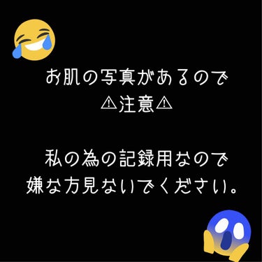 肌荒れの記録。


随分、期間あいてしまったけど…
ようやっとスッピンを人に見せられるレベルまで
たどり着いた。長かった（ ;  ; ）

今まで


石鹸で洗顔＆化粧水なし＆気まぐれでワセリン
　　　