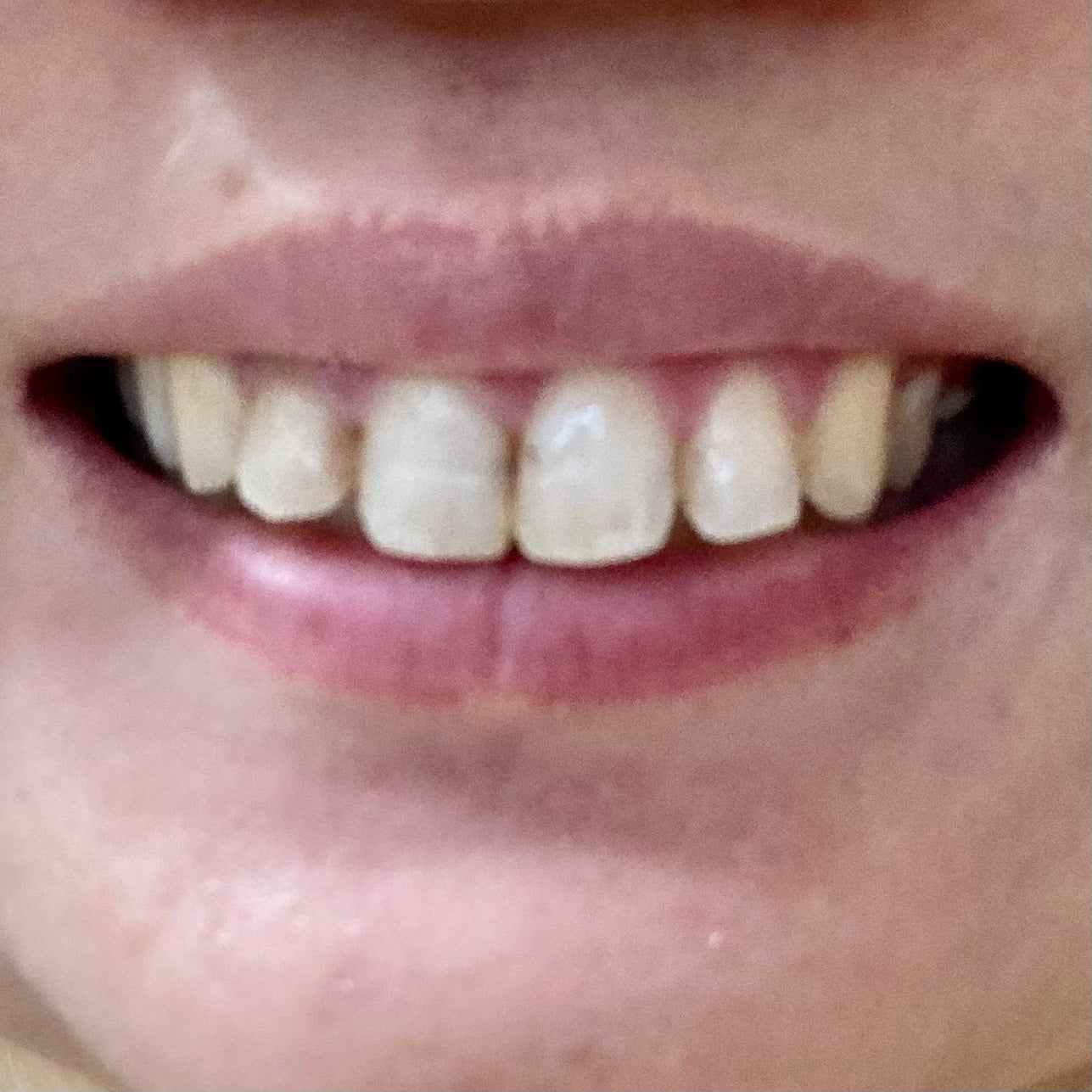 ミュゼホワイトニング 速攻美白 ポリリンキューブ 3個入り/ミュゼホワイトニング/歯磨き粉を使ったクチコミ(4枚目)