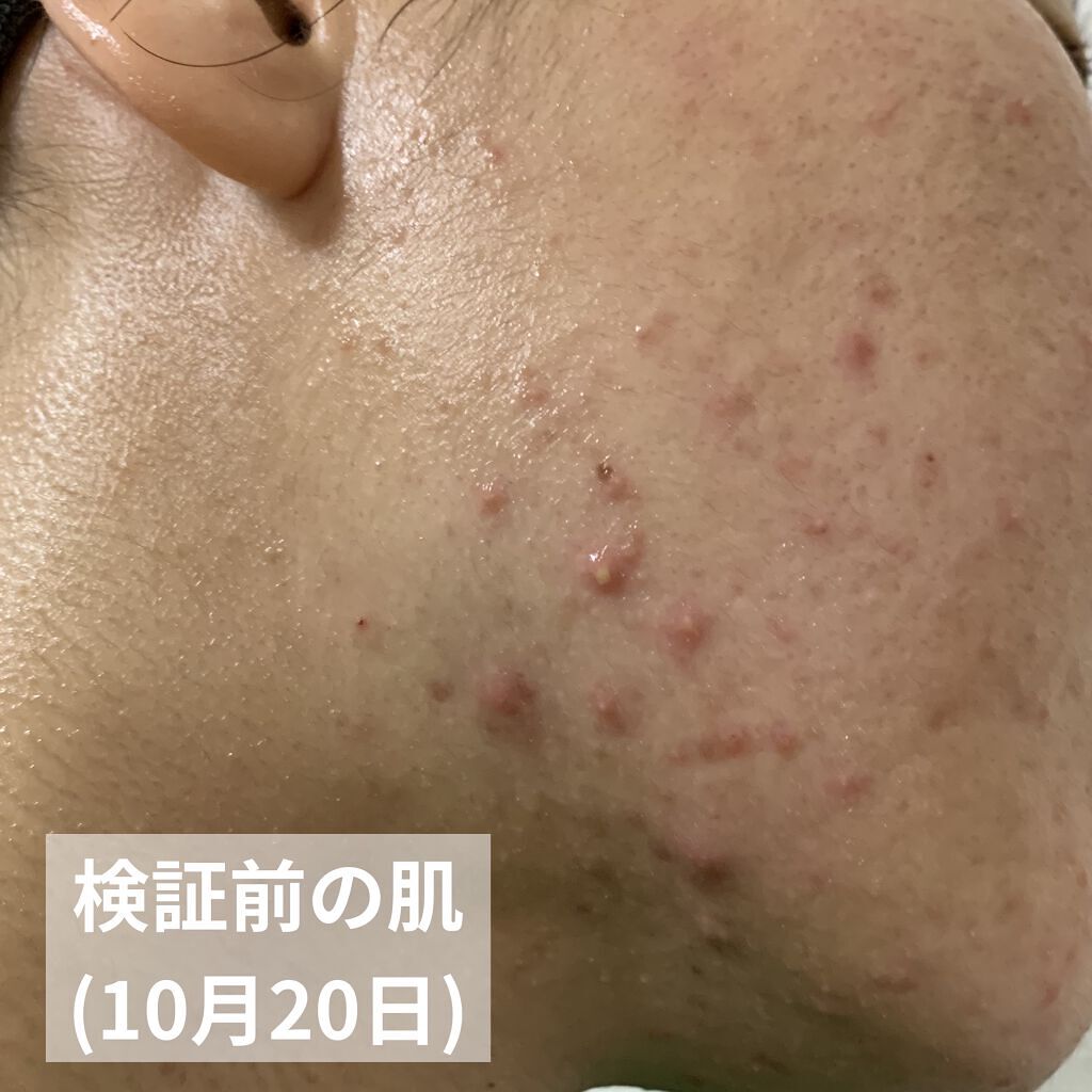 ペアアクネクリームW(医薬品)/ペア/その他を使ったクチコミ（3枚目）