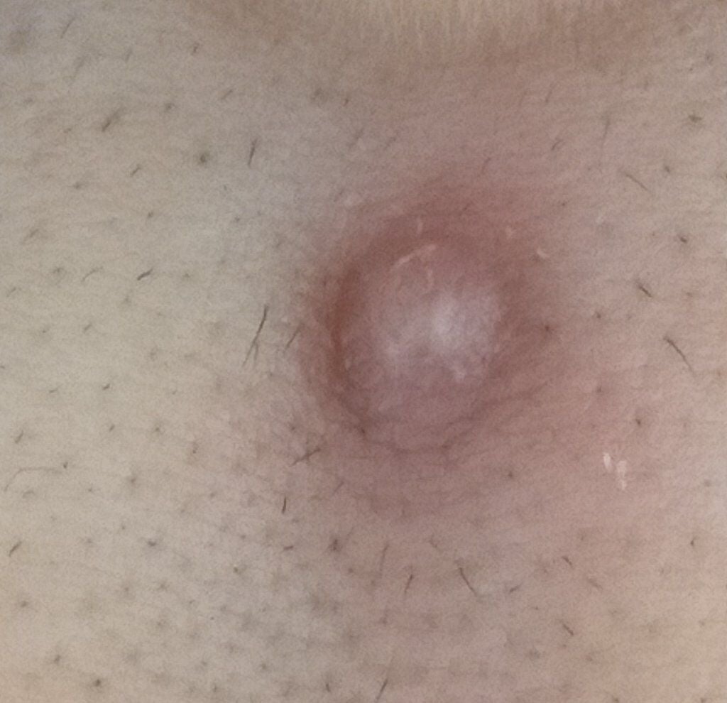 オロナインH軟膏 (医薬品)/オロナイン/その他を使ったクチコミ(4枚目)