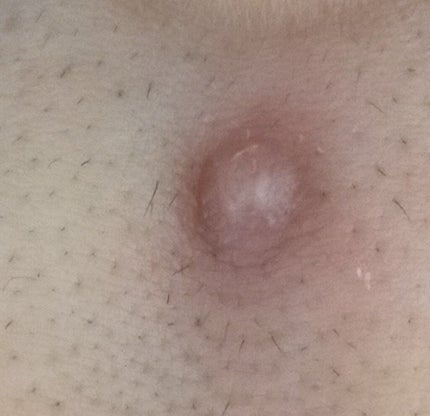 オロナインH軟膏 (医薬品)/オロナイン/その他を使ったクチコミ(4枚目)