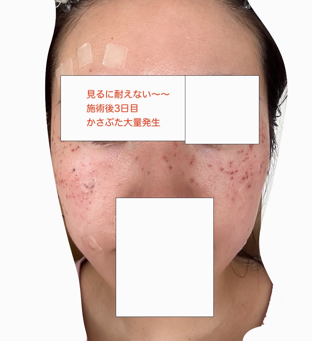 minaㅋㅋㅋ on LIPS 「韓国ソウル江南にある【you&i美容クリニック】にてシミ取り施..」(7枚目)