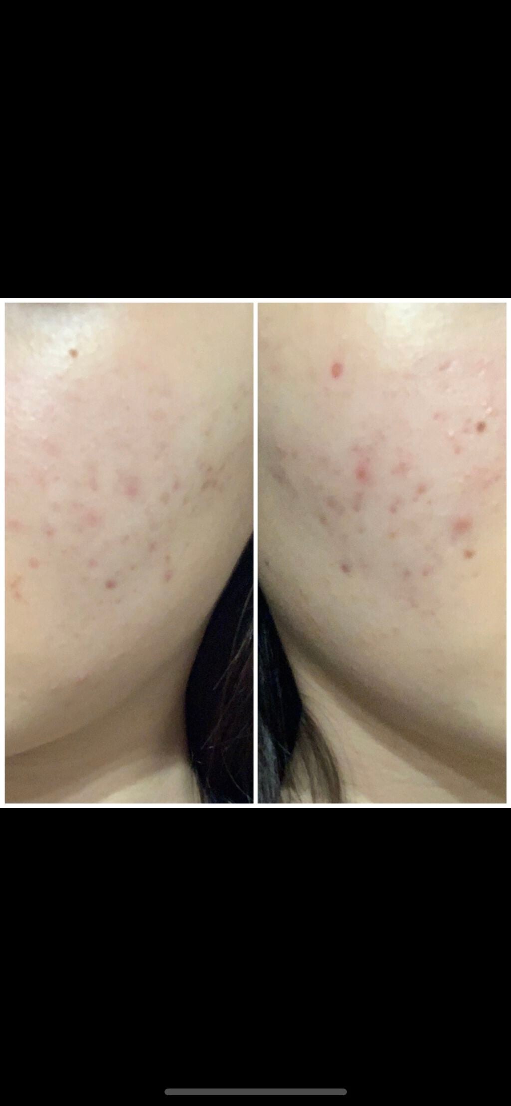 あんぱん on LIPS 「べピオゲル開始から2週間!2枚目⇨8/283枚目⇨開始日肌はツ..」(3枚目)