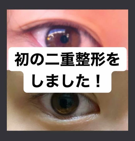 二重整形/その他を使ったクチコミ(1枚目)