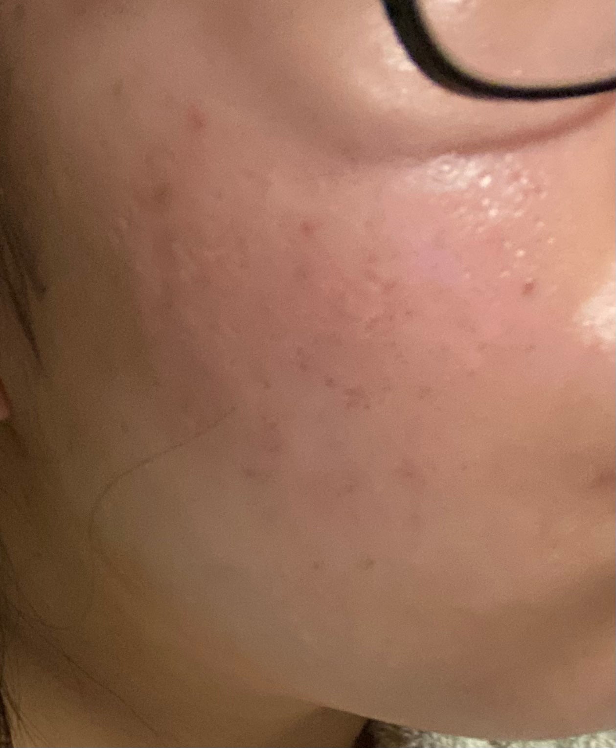 薬用しみ集中対策 プレミアム美容液/メラノCC/美容液を使ったクチコミ(3枚目)