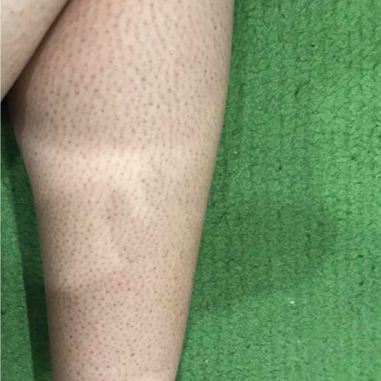 ケアノキュア(医薬品)/小林製薬/その他を使ったクチコミ(2枚目)