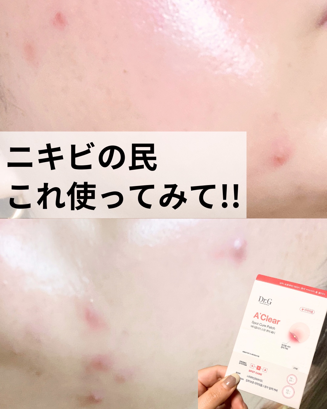 Dr.G Aクリアスポットパッチ/Dr.G/その他スキンケアを使ったクチコミ（1枚目）