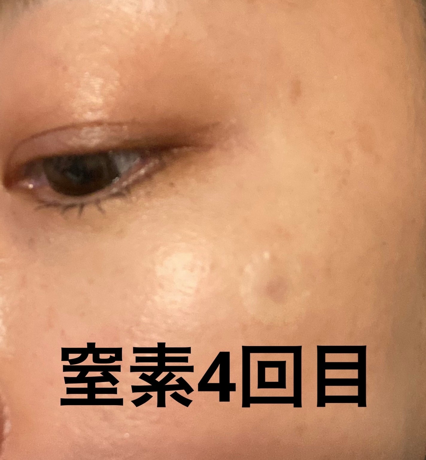 ためしたがり43歳 on LIPS 「4回目の窒素#イボ時間が開いてしまいました。忙しくて💦かなり平..」(1枚目)