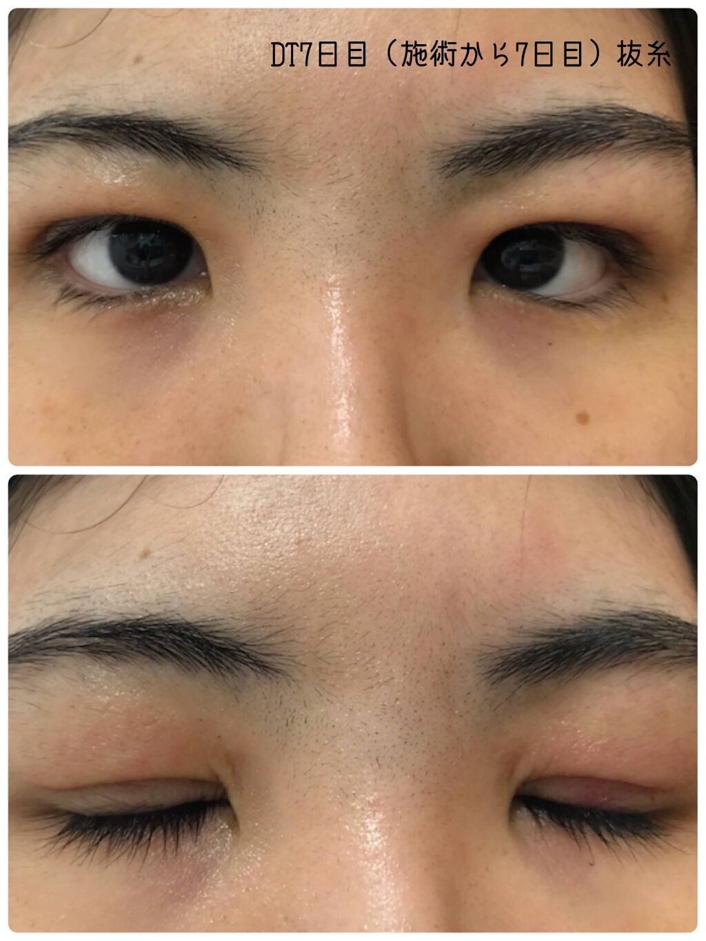 あーる@二重切開DT中 on LIPS 「【閲覧注意】二重整形(全切開)レポ-経過編-2月16日に二重整..」(7枚目)