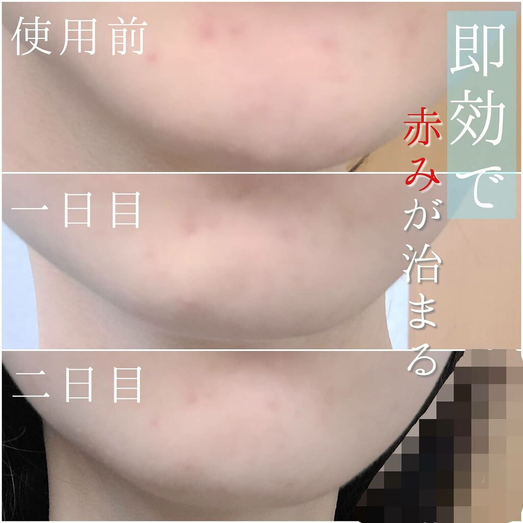 ビタB ACコントロールクリーム/SKIN&LAB/フェイスクリームを使ったクチコミ（1枚目）