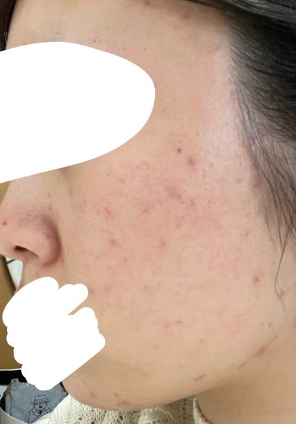 ディフェリンゲル0.1% /マルホ株式会社/その他を使ったクチコミ(2枚目)