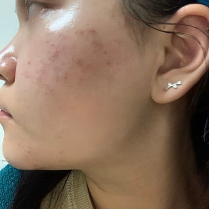 ティーツリーケア ソリューション エッセンシャルマスクEX/MEDIHEAL/シートマスク・パックを使ったクチコミ(3枚目)