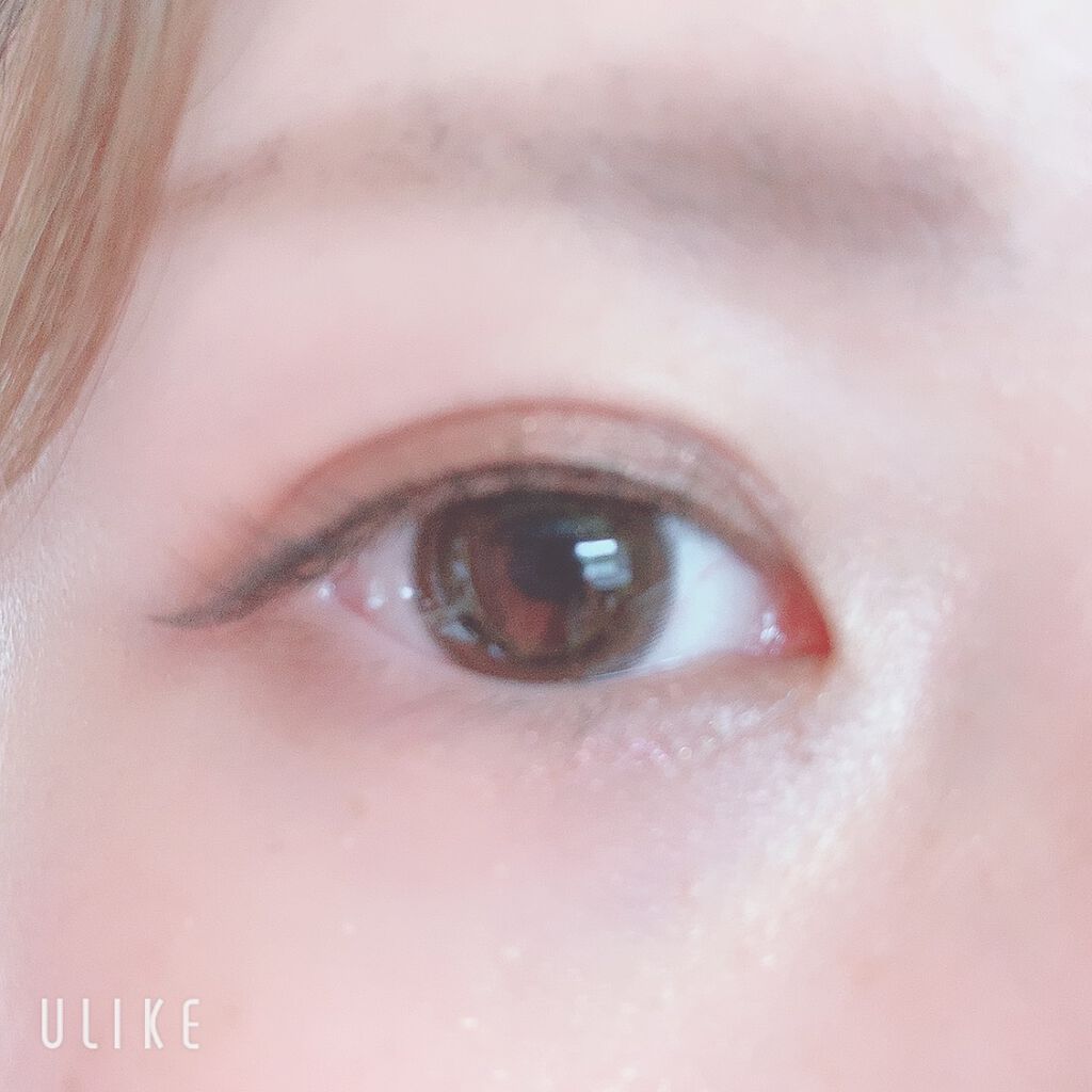 二重整形/その他を使ったクチコミ（2枚目）