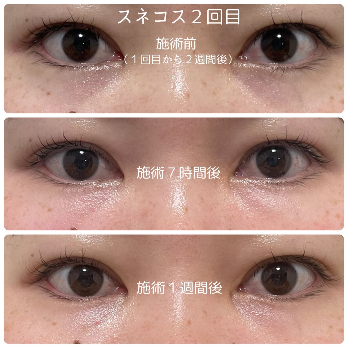 もい on LIPS 「今回、モティーフ銀座クリニックでスネコス注射3回の施術を受けま..」(4枚目)