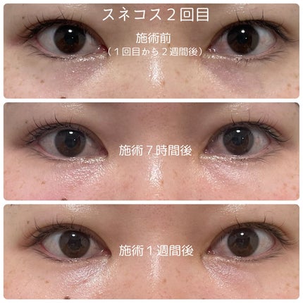 もい on LIPS 「今回、モティーフ銀座クリニックでスネコス注射3回の施術を受けま..」(4枚目)