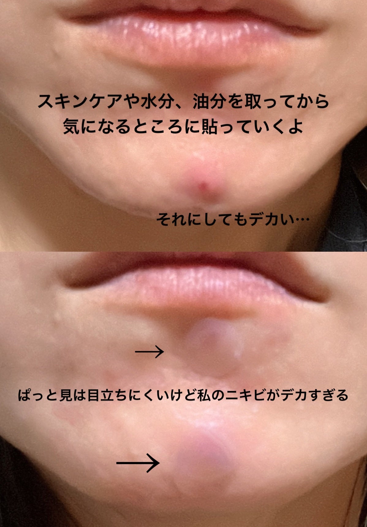 プロCICA クリアスポットパッチ/VT/その他スキンケアを使ったクチコミ(4枚目)