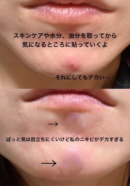 プロCICA クリアスポットパッチ/VT/その他スキンケアを使ったクチコミ(4枚目)