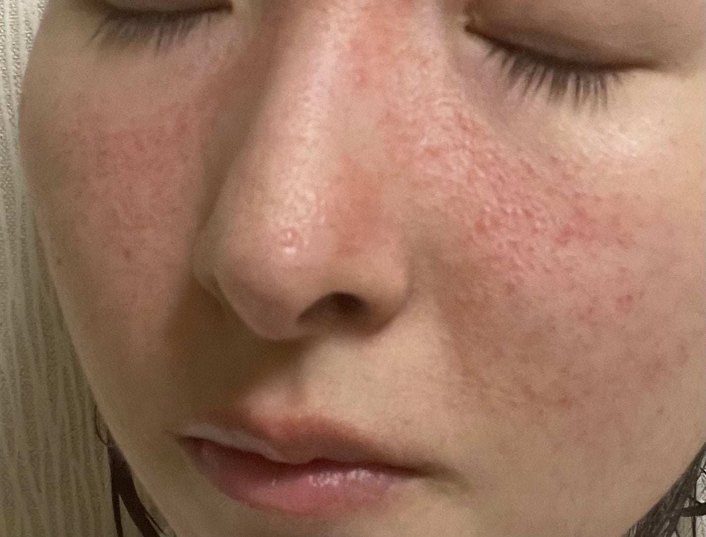 Mikaringo on LIPS 「前回の皮膚科受診から20日経ちました🍀酒さについて自分なりに調..」(2枚目)