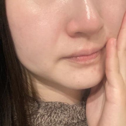 メディリフト ニードルリフトピールセラム/YA-MAN TOKYO JAPAN/美容液を使ったクチコミ(4枚目)