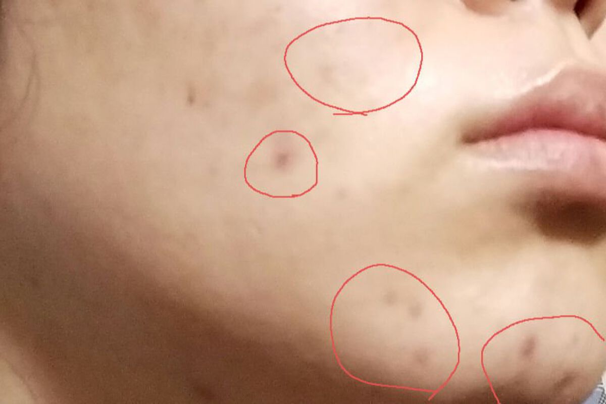 バイオイル/バイオイル/フェイスオイルを使ったクチコミ（2枚目）