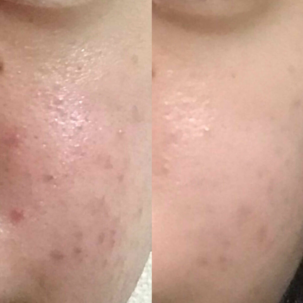 ペアアクネクリームW(医薬品)/ペア/その他を使ったクチコミ（3枚目）