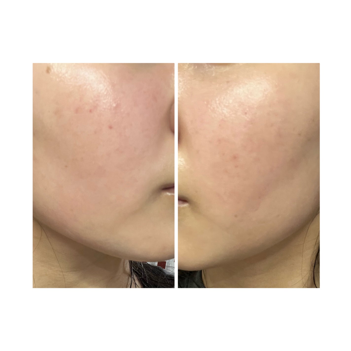 ぽむ on LIPS 「2023.9.13皮膚科に受診 エピデュオとヘパリン処方1枚目..」(3枚目)