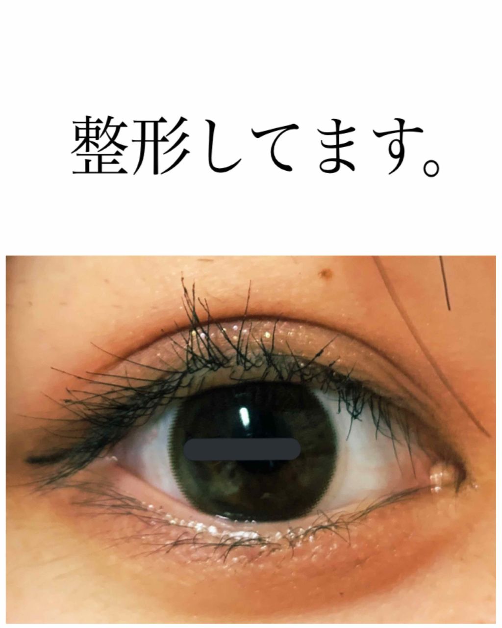 ♡ on LIPS 「高校生の時に、全切開という美容整形でぱっちり二重になりました。..」(1枚目)