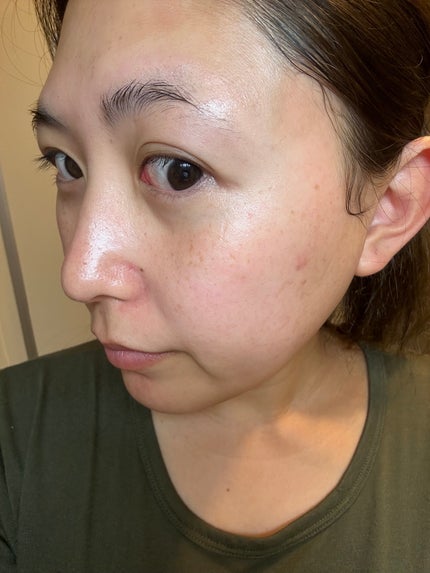 ネイチャーコンク 薬用クリアローション/ネイチャーコンク/拭き取り化粧水を使ったクチコミ(6枚目)