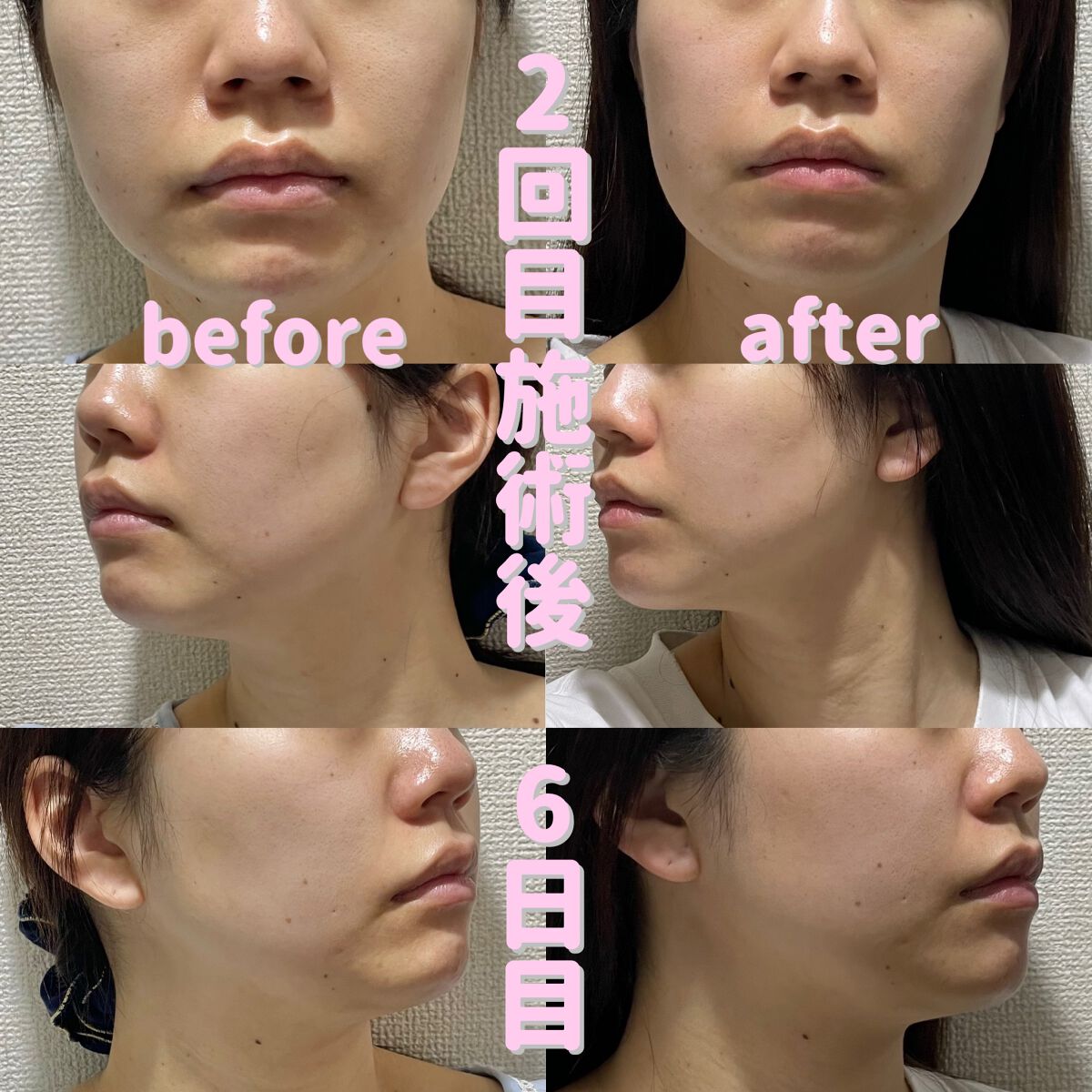 輪郭スッキリQ+/湘南美容/その他を使ったクチコミ（2枚目）