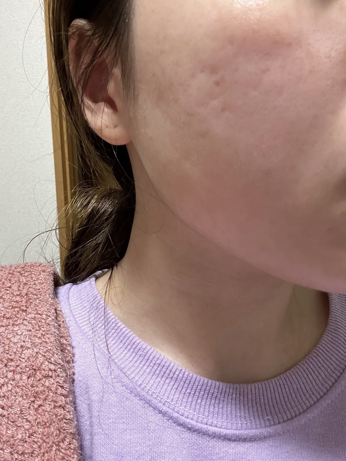 エファクラ ピールケア セラム/ラ ロッシュ ポゼ/美容液を使ったクチコミ（1枚目）