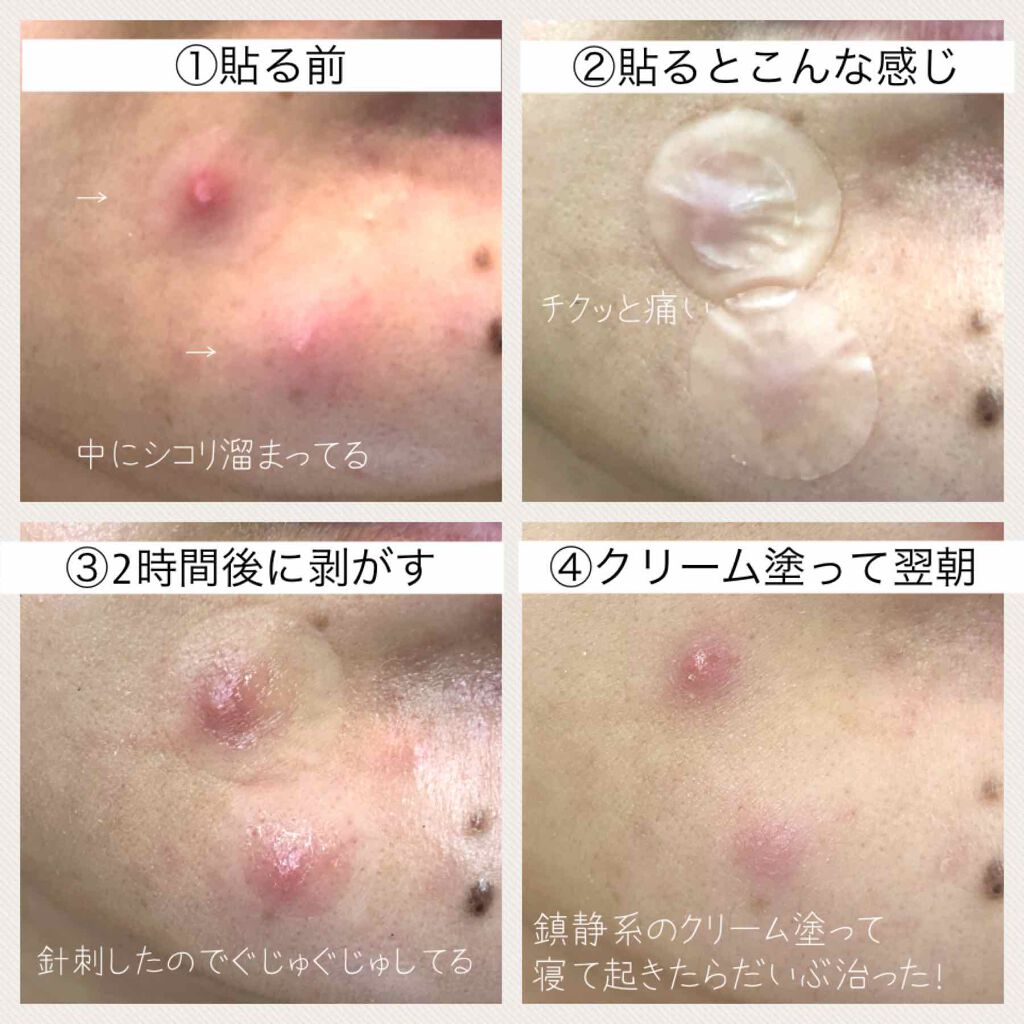 ACケア/ACROPASS/シートマスク・パックを使ったクチコミ(3枚目)