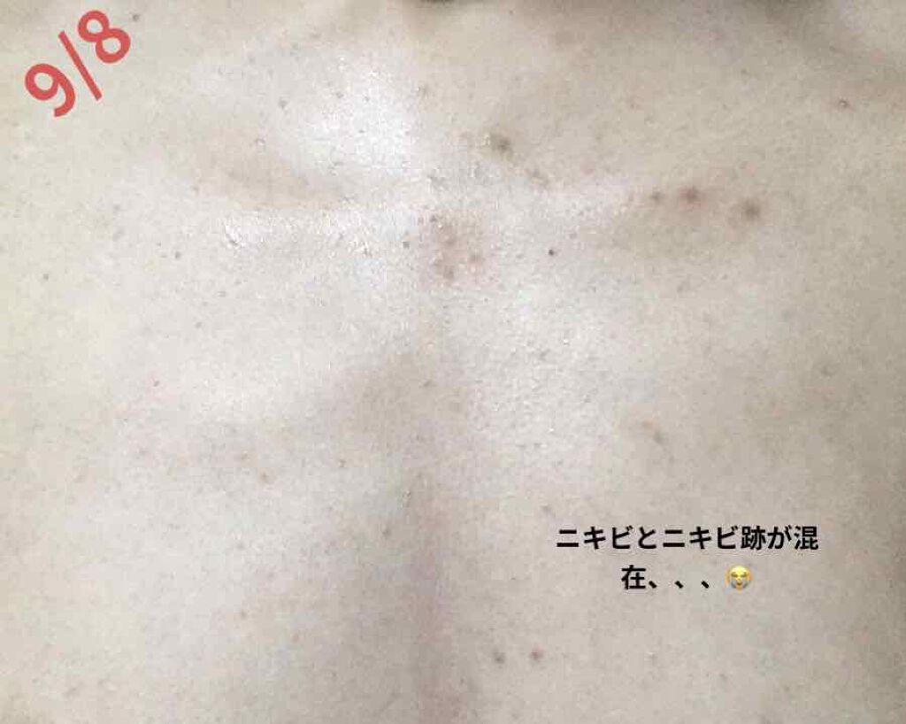 オロナインH軟膏 (医薬品)/オロナイン/その他を使ったクチコミ(4枚目)